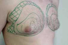 Fettabsaugung Brust Moers