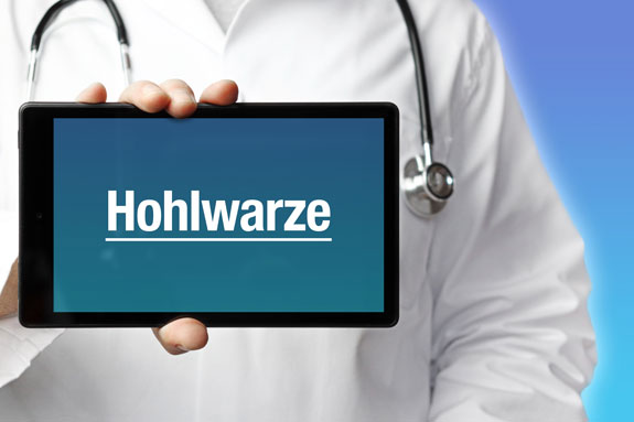 Schlupfwarzen Moers